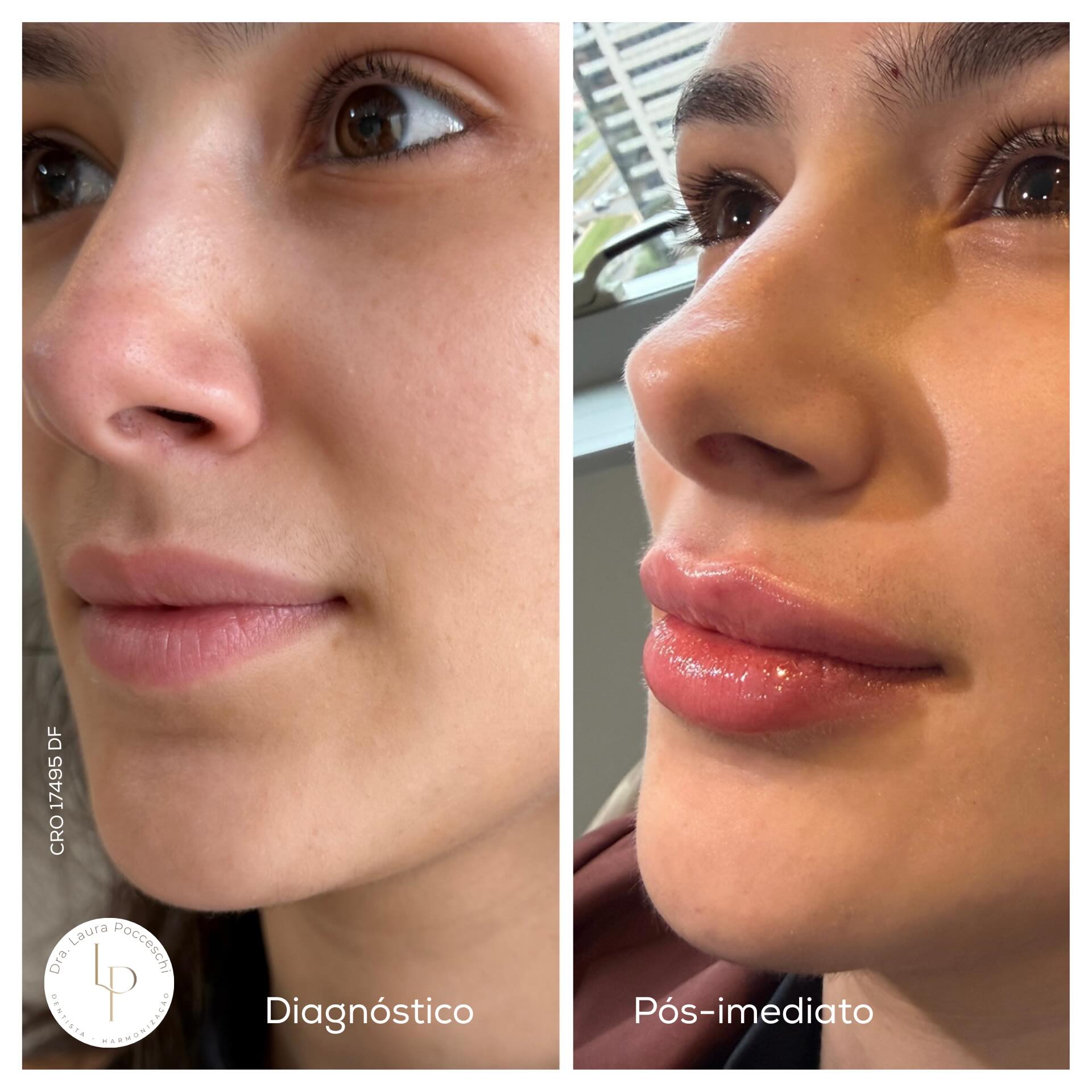 Preenchimento labial